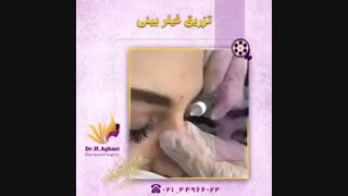 فیلم واقعی تزریق فیلر به بینی دندانپزشک زیبایی