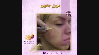 فیلم واقعی تزریق مزوژل لیزر فرکشنال