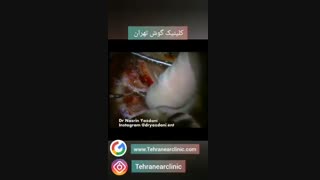 جراحی کاشت حلزون گوش