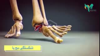 فیلم کوتاه از چگونگی شکستگى مچ پا