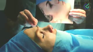 جراحی بینی - نتیجه بلافاصله بعد از عمل!