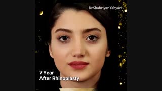 نمونه کار جراحی زیبایی بینی