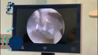 جراحی منیسک دیسکویید