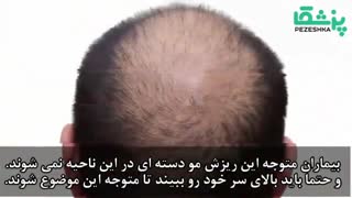 همه چیز درباره ریزش مو
