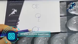 همه چیز درباره دررفتگی مکرر شانه