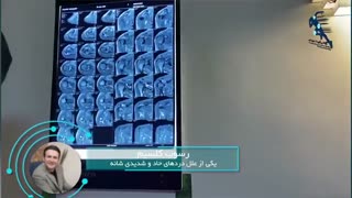 درمان شانه درد شدید