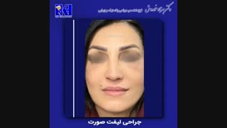 جراحی لیفت صورت