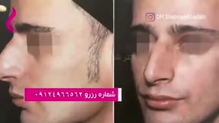 بلافاصله پس از جراحی بینی