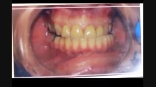 بهترین روکش سرامیکی دندان (دکتر بهمن پوراقدم) 02122220000