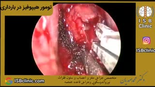 تومور هیپوفیز در بارداری