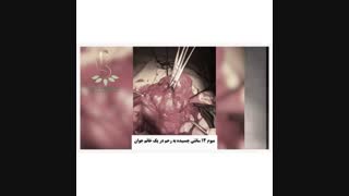 خارج کردن میوم ١٤ سانتى چسبیده به رحم در یک خانم جوان