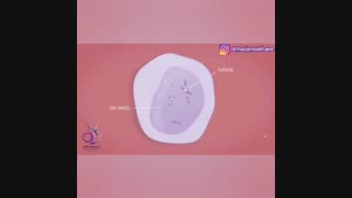 سرطان تخمدان در زنان