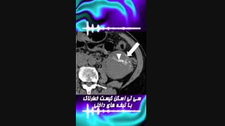 کیستهای معمولی و شایع کلیه