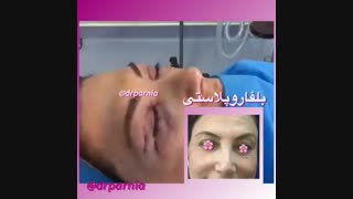 فیلم جراحی پلک