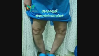 فیلم واقعی درمان آرتروز شدید زانو با تعویض مفصل