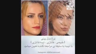 جراحی بینی طبیعی بعد از دو ماه به روش بسته مدرن