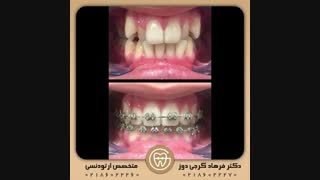 ارتودنسی ثابت دو فک | دکتر فرهاد گرجی دوز