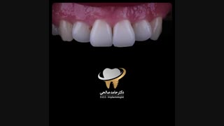 اصلاح طرح لبخند با استفاده از لمینت سرامیکی | دکتر حامد صالحی