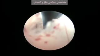 درمان هیدروسفالی