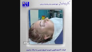 فیلم لیفت ابرو و تزریق چربی به پلک