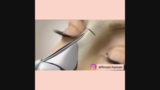 جراحی بینی را با انیمیشن ببینید