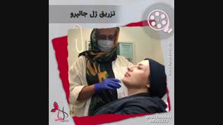 فیلم تزریق ژل جالپرو