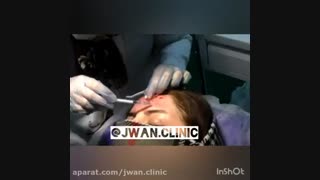 مزوتراپی پوست صورت توسط دکتر ناهید همتیان