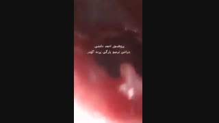 چسبندگی استخوانچه گوش میانی