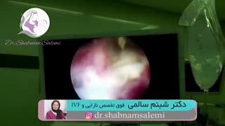 هیستروسکوپی خارج کردن فیبروم