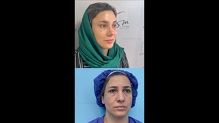 رفع الحاجب بالمنظار وتجمیل الأنف وجراحة الجفن السفلی