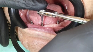 متخصص ایمپلنت در تهران