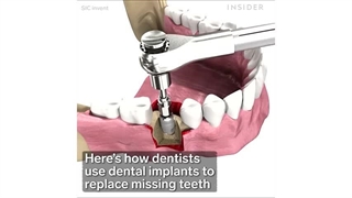 ایمپلنت دندان؛ راهکاری دائمی برای جایگزینی دندان‌های از دست رفته