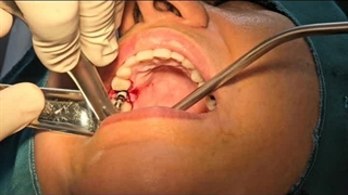 ایمپلنت دندان خانم داوودی در مطب دکتر حمید پورصادقی واقع در میدان پاستور تهران