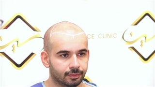 کاشت مو به روش جدید sut کاشت مو