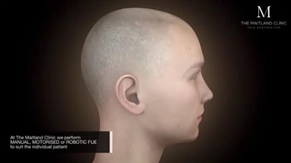 کاشت مو به روش FUE: روشی پیشرفته و طبیعی برای احیای مو